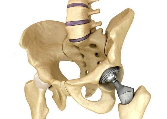 Endoprosthetics of the hip joint