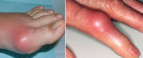 Occurrence of joints with arthritis