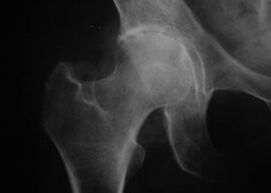 X-ray of the hip joint with osteoarthritis