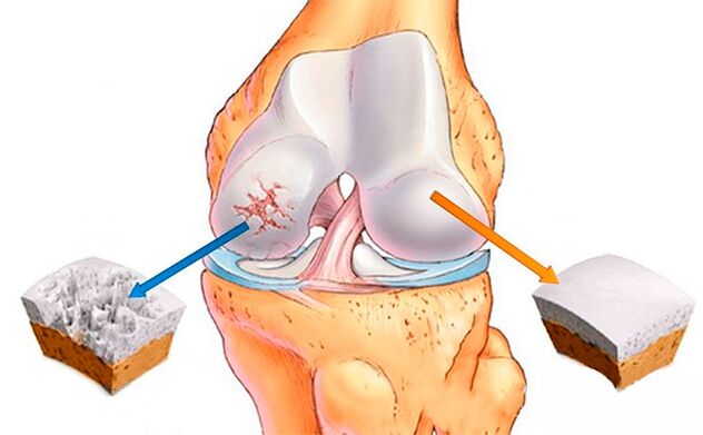 A normal knee joint (right) and one affected by osteoarthritis (left)