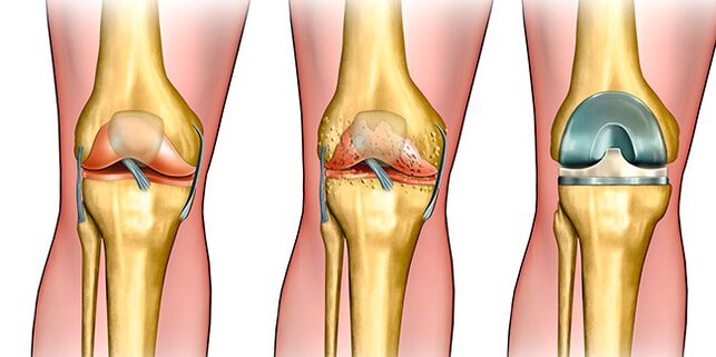 In the third stage of osteoarthritis, a knee joint replacement is required