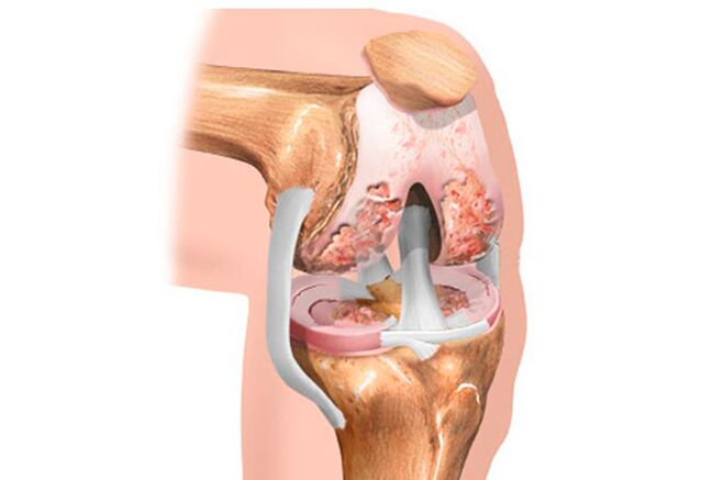 Osteoarthritis of the knee joint