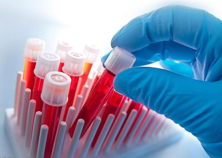 Blood test for osteochondrosis