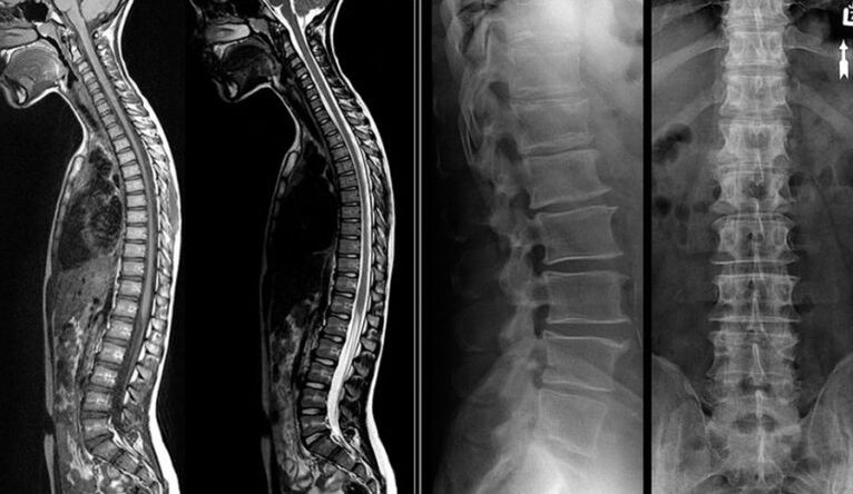 X-ray and MRI images in osteochondrosis