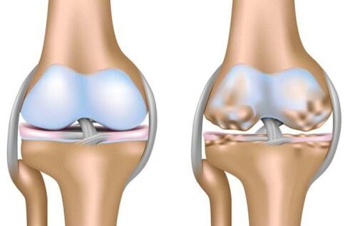 healthy joint and destruction of the knee joint in arthrosis