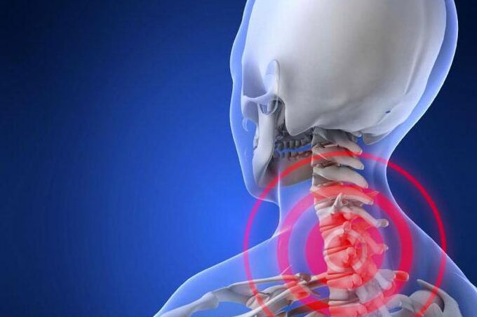 Lancinating pain in the neck - an early symptom of cervical osteochondrosis