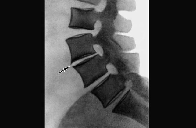 Manifestations of osteochondrosis of the thoracic spine in the X-ray image