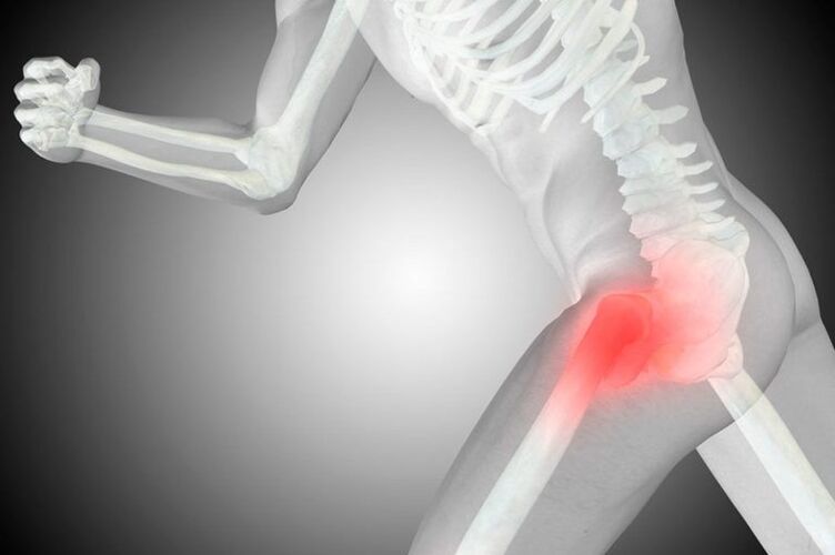 Coxarthrosis of the hip joint