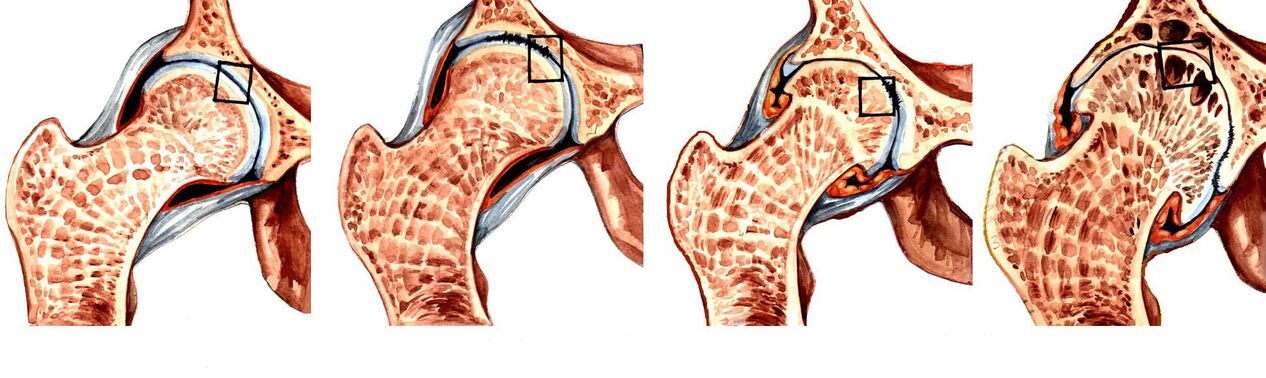 Degrees of deforming coxarthrosis