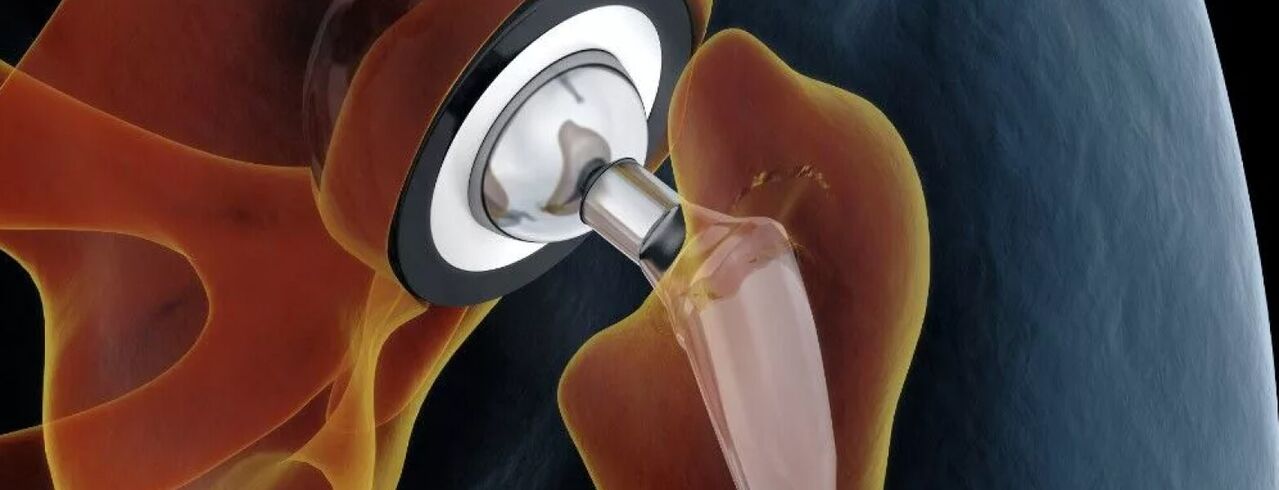 Hip arthroplasty in late-stage coxarthrosis