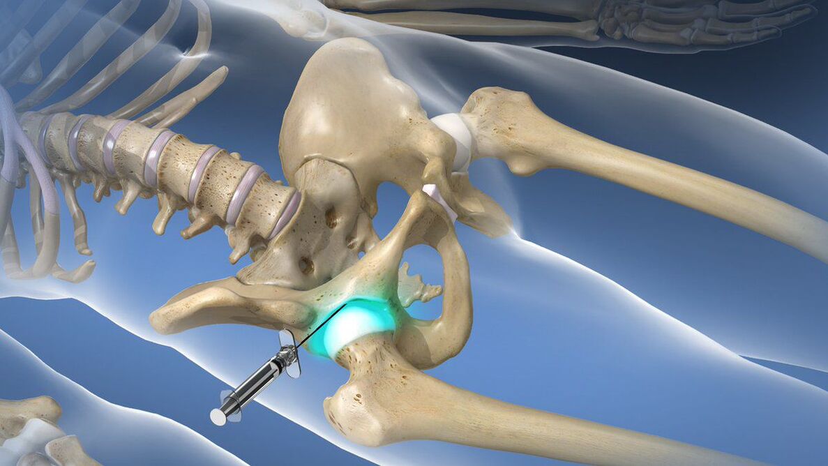 Intra-articular blockade to eliminate acute pain in coxarthrosis