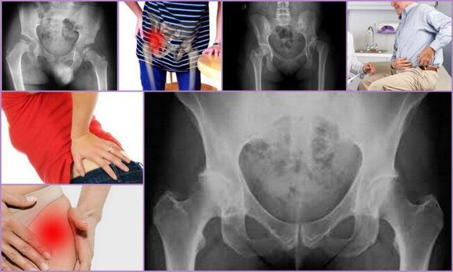 Pain and restricted mobility are the main symptoms of osteoarthritis of the hip