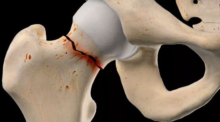 The femoral neck fracture is one of the causes of secondary coxarthrosis. 